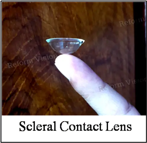 WHAT IS SCLERAL CONTACT LENS