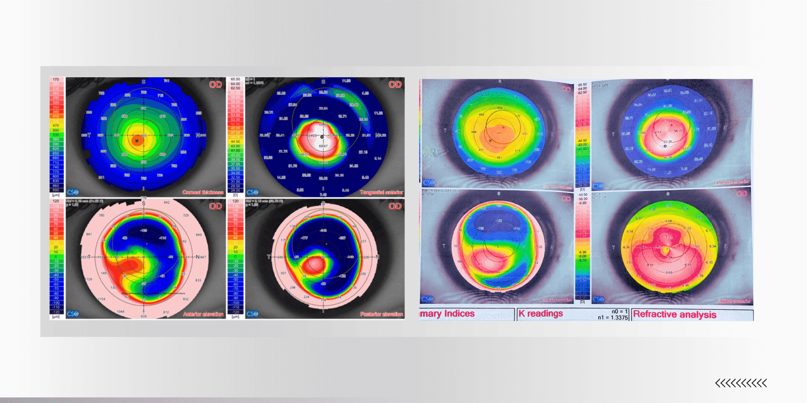 Best Non-Surgical Treatment for Keratoconus in 2025: Scleral Lenses ...