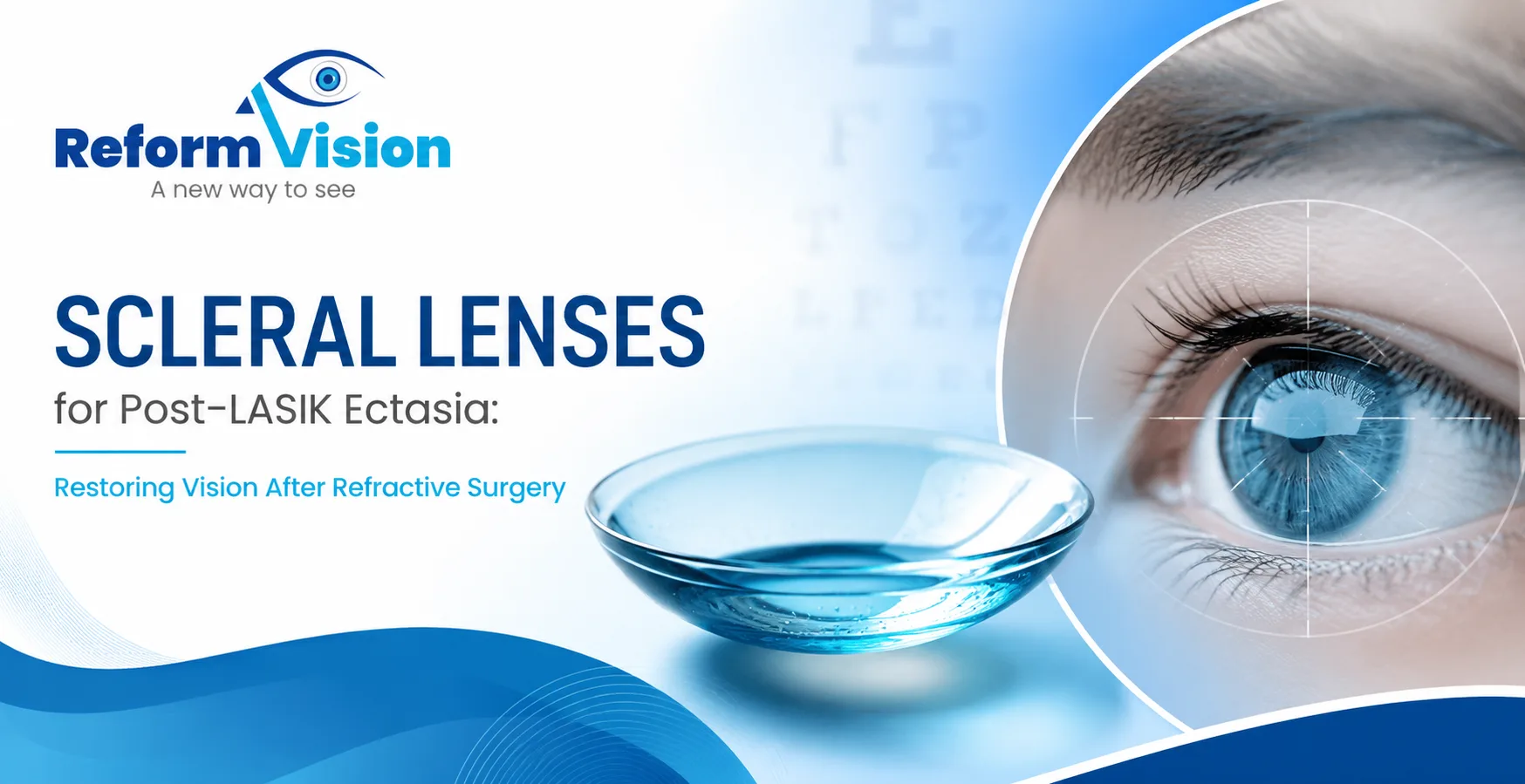 Scleral Lenses for Post-LASIK Ectasia: Restoring Vision After Refractive Surgery