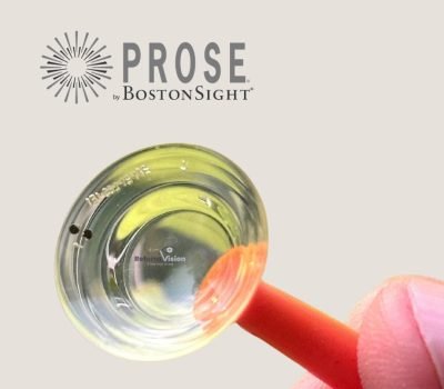 Keratoconus & Irregular Cornea Lenses - Reform Vision