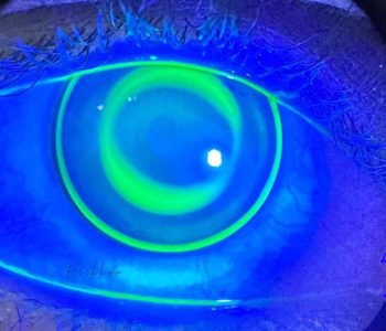 Orthokeratology