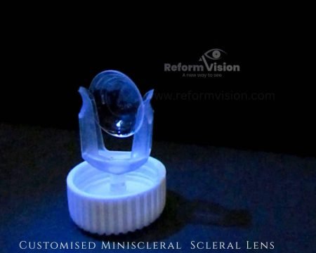 Scleral Lens